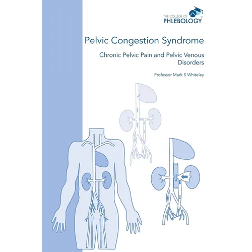 Pelvic Congestion Syndrome - Chronic Pelvic Pain and Pelvic Venous Disorders - Paperback